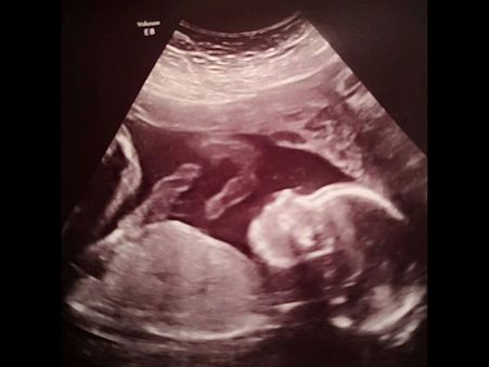 The Couple Were Asked To Terminate The Pregnancy