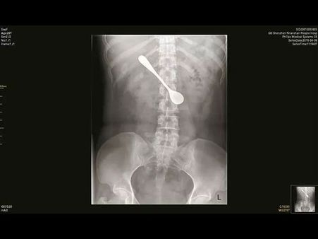 She Used The Spoon To Dislodge Fish Bone