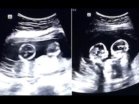 The Father Was Amused Seeing This Action Of His Unborn Babies