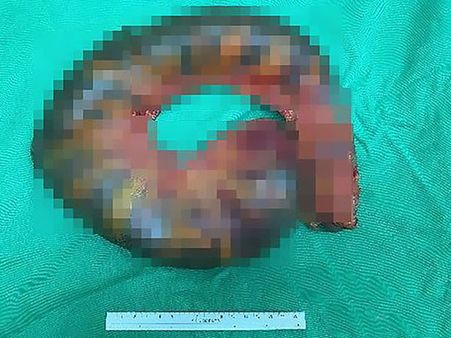 They Discovered His Intestines Were Full Of Faeces