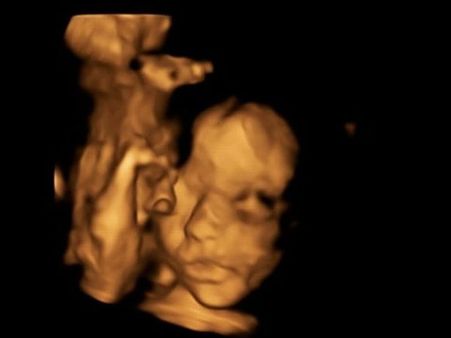 The Doctors Offered A New Option Called Foetal Surgery