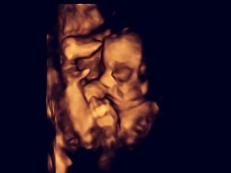 The Baby Was Later Put Back In The Womb