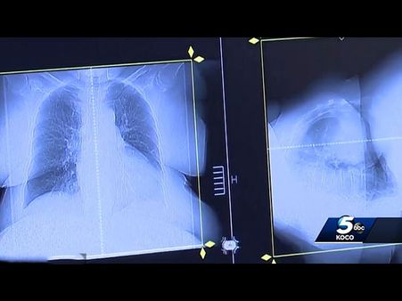 His Cancer Had Spread To Other Organs Of His Body