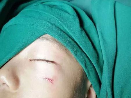 He Had Been Running Around With The Pencil In His Hand