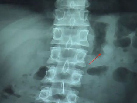 He Did Not Feel Any Discomfort