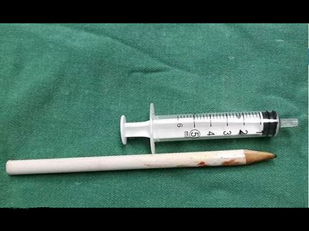 The Surgeons Removed The Pencil