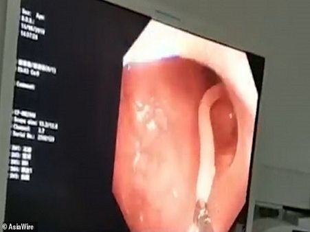 The Worm Was Removed Instantly