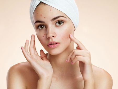 13. Acne (11th week)