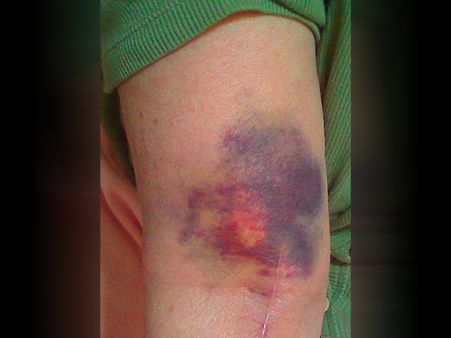 What Causes Vitamin K Deficiency 