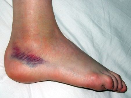 Symptoms Of Vitamin K Deficiency