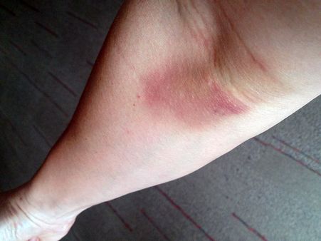 Risk Factors Of Vitamin K Deficiency