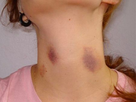 Treatment Of Vitamin K Deficiency