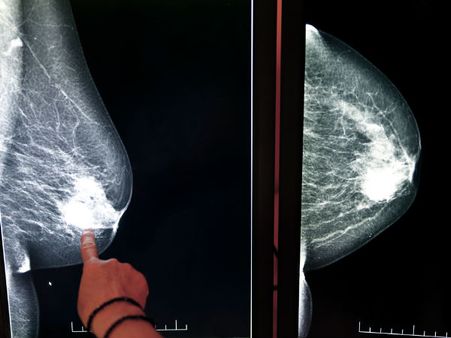 9. Undergo screening every month