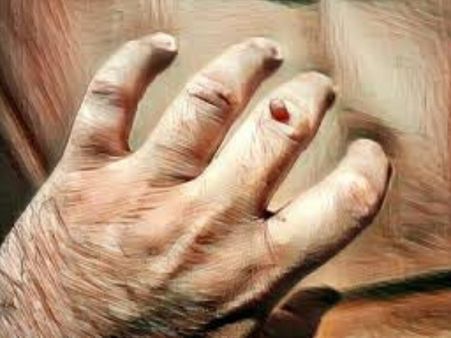 Symptoms Of Human Papillomavirus And Herpes