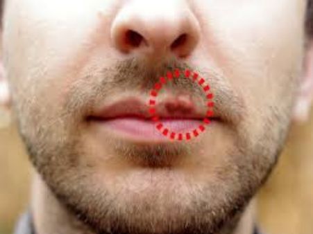 Who Is At Risk Of Human Papillomavirus And Herpes