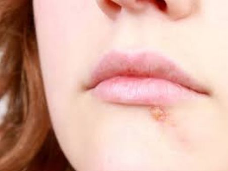 Complications Of Human Papillomavirus And Herpes