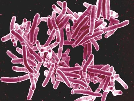 What Causes Tuberculosis What Causes Tuberculosis