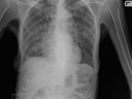 What Are The Symptoms Of Tuberculosis What Are The Symptoms Of Tuberculosis