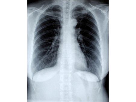 Diagnosis Of Walking Pneumonia