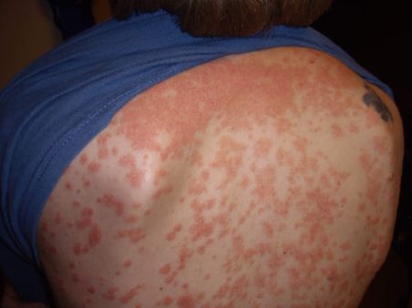 Diagnosis Of Psoriasis