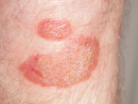 Types Of Psoriasis