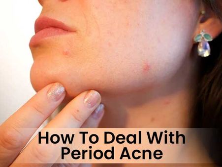Why Do You Get Period Acne?