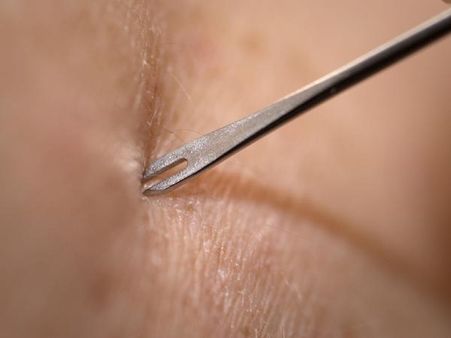 Prevention And Treatment Of Smallpox Prevention And Treatment Of Smallpox