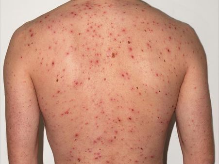 What Is The Difference Between Smallpox And Chickenpox? What Is The Difference Between Smallpox And Chickenpox?