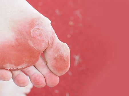 Symptoms Of Athlete’s Foot