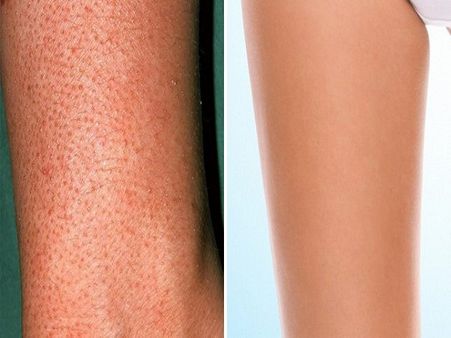 Dry Shaving Can Lead To Strawberry Legs