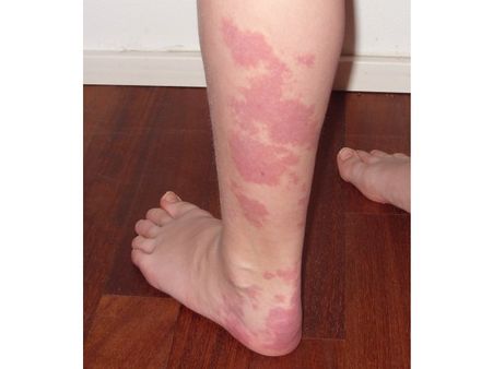 1. Vascular birthmarks 