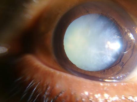 What Causes Cataracts?
