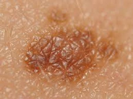 11. Skin Cancer test