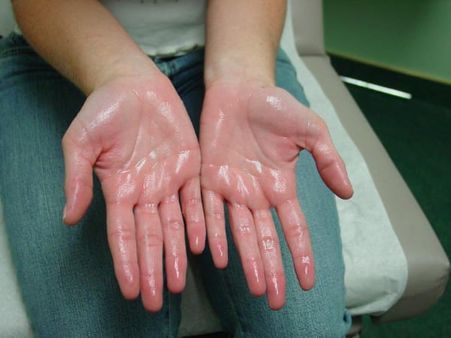 What Is Hyperhidrosis?
