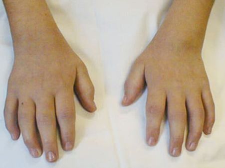 Types Of Juvenile Idiopathic Arthritis 