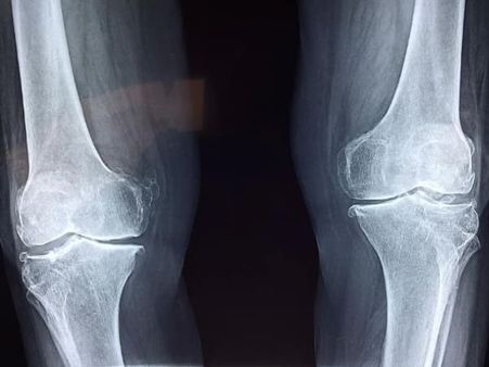 Diagnosis Of Osteosarcoma
