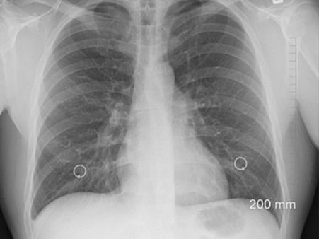 Diagnosis Of Pneumothorax Diagnosis Of Pneumothorax