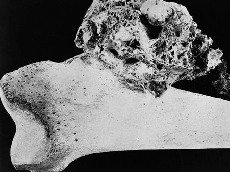 Types Of Osteosarcoma