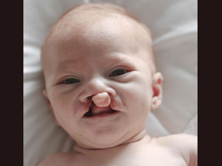 Symptoms Of Cleft Lip and Palate
