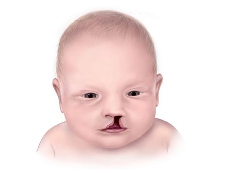 What Is Cleft Lip and Palate?