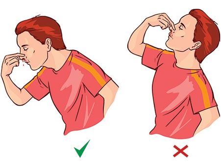 2. Don’t lean backwards during a nose bleed
