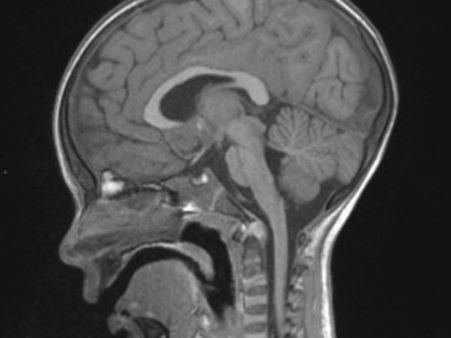 Diagnosis Of Cerebral Palsy