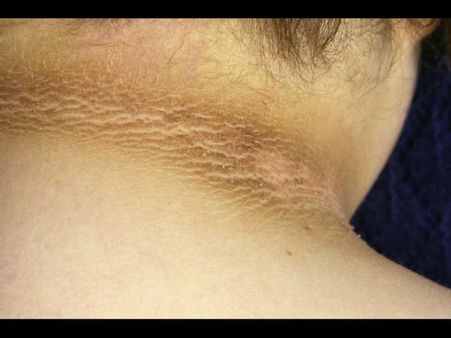 8. Darkening of the skin 