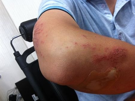 What Happens In Crush Syndrome?