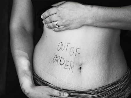 Herbs For Stretch Marks