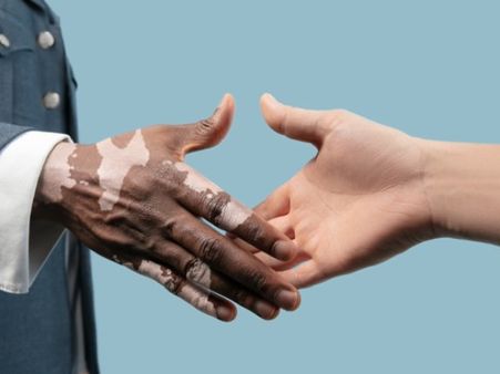 What Are The Complications Of Vitiligo? What Are The Complications Of Vitiligo?