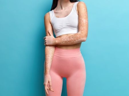 What Is Vitiligo? What Is Vitiligo?