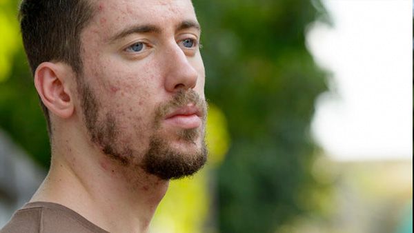 9. Beard acne
