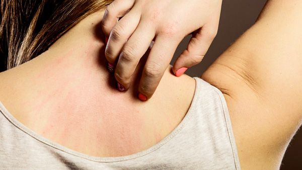 Symptoms Of Zika Virus Infection