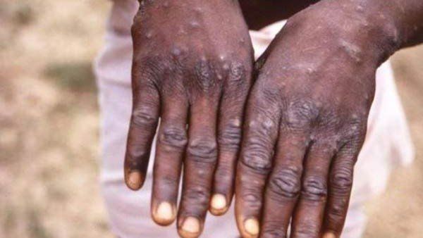 What Is Monkeypox?